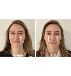 Dark Circles Before and After